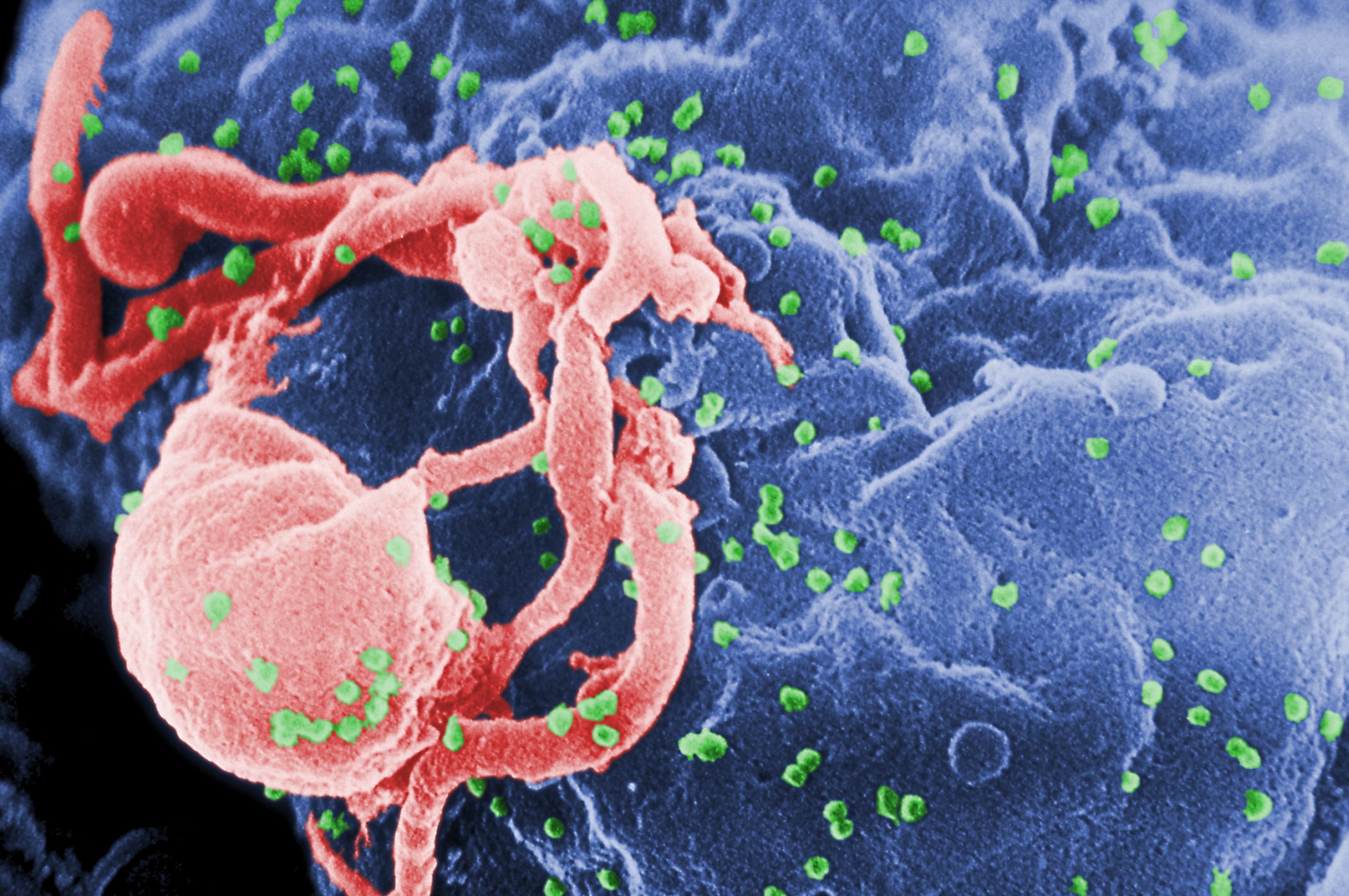 Cure for AIDS on the Horizon?